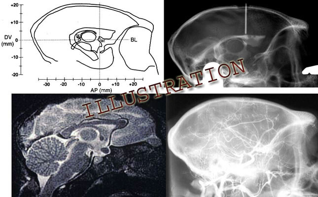 sagittal montage